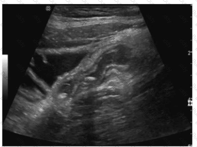 AB-Abdomen Question 46