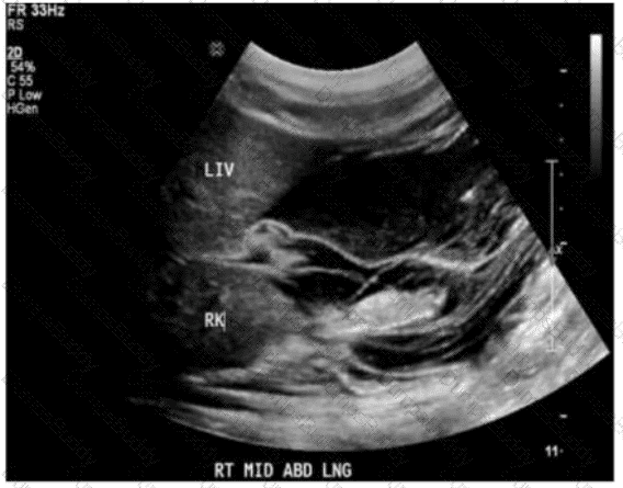 AB-Abdomen Question 42