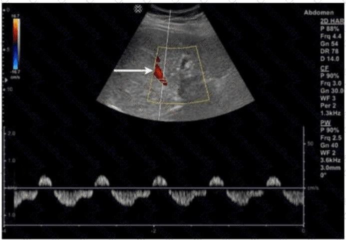 AB-Abdomen Question 43