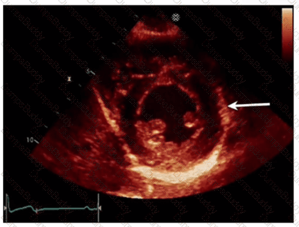 AE-Adult-Echocardiography Question 13