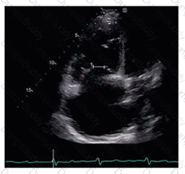 AE-Adult-Echocardiography Question 18